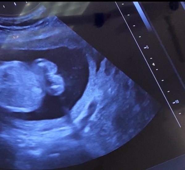 Bild zu Junge oder Mädchen ? 18 ssw - Schwanger - wer noch? Rund um die Schwangerschaft
