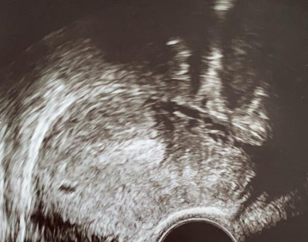 Bild zu Ultraschall 5+3ssw - Schwanger - wer noch? Rund um die Schwangerschaft