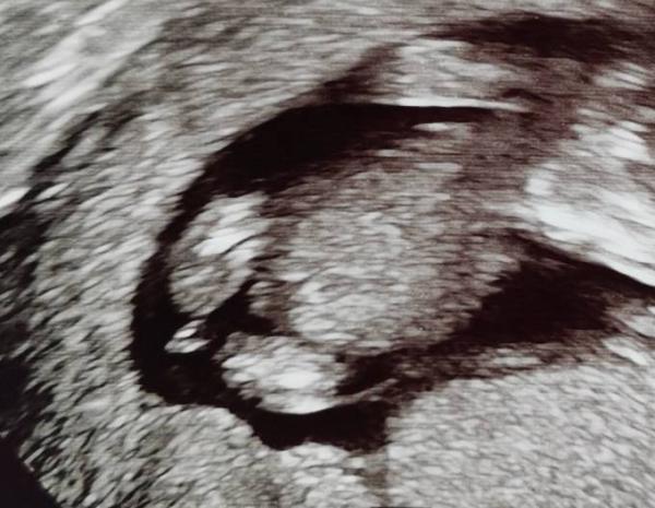 Bild zu Mädchen oder junge? - Schwanger - wer noch? Rund um die Schwangerschaft