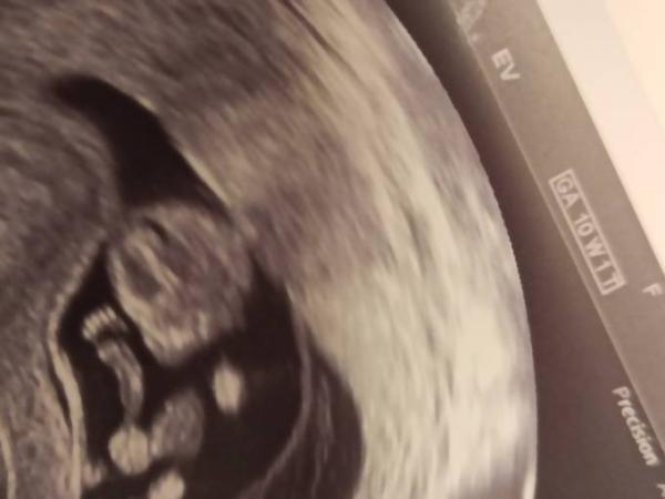 Bild zu Komisches Ultraschall?? - Schwanger - wer noch? Rund um die Schwangerschaft