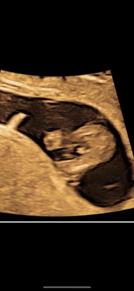 Bild zu 13ssw - Schwanger - wer noch? Rund um die Schwangerschaft