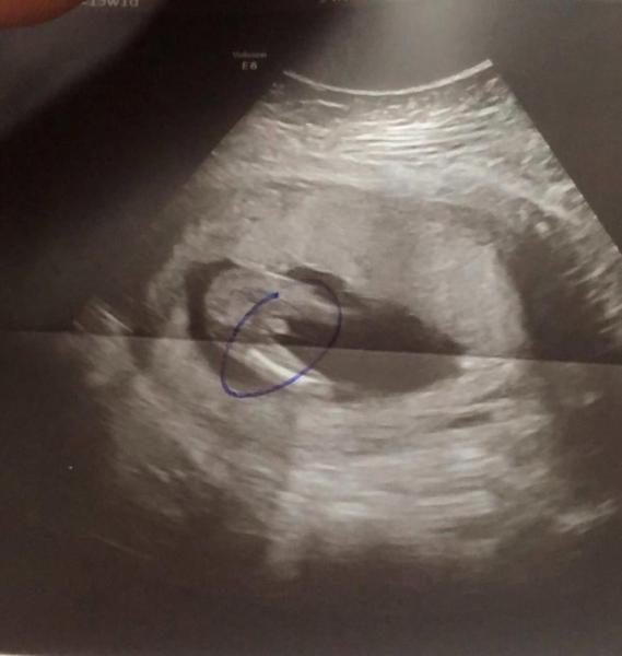 Bild zu Geschlecht Baby - Schwanger - wer noch? Rund um die Schwangerschaft