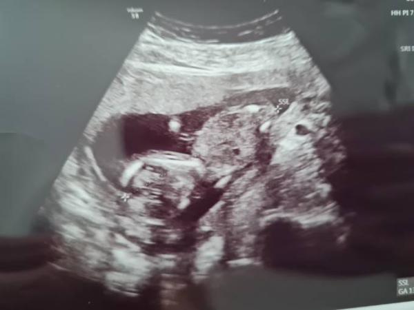 Bild zu Mädchen oder Junge - Schwanger - wer noch? Rund um die Schwangerschaft