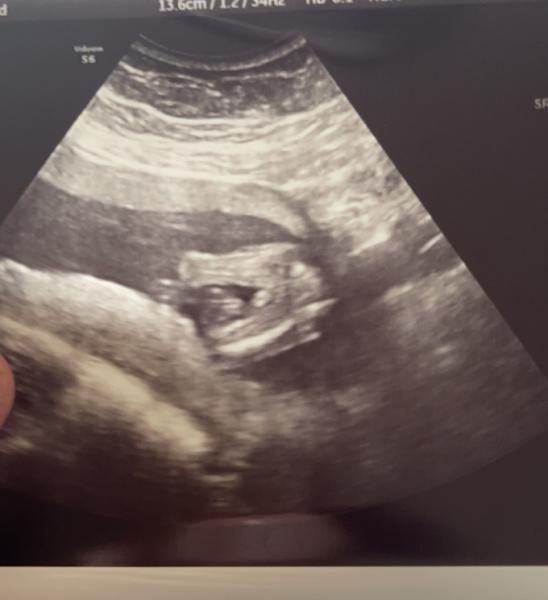 Bild zu 17 SSW eindeutig Junge ? - Schwanger - wer noch? Rund um die Schwangerschaft