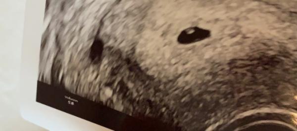 Bild zu Ultraschall 5 +1 - Schwanger - wer noch? Rund um die Schwangerschaft