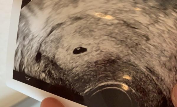Bild zu Ultraschall 5+1 - Schwanger - wer noch? Rund um die Schwangerschaft