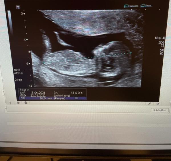 Bild zu Geschlecht vom Baby - Schwanger - wer noch? Rund um die Schwangerschaft