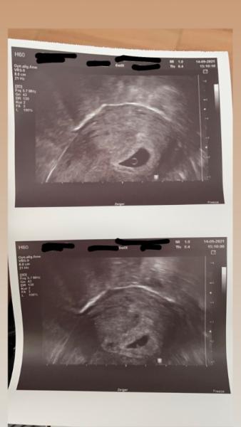 Bild zu Ultraschall 6+0 Embryo??? - Schwanger - wer noch? Rund um die Schwangerschaft