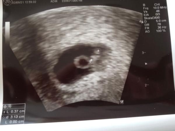 Bild zu Kann embryo schrumpfen - Schwanger - wer noch? Rund um die Schwangerschaft
