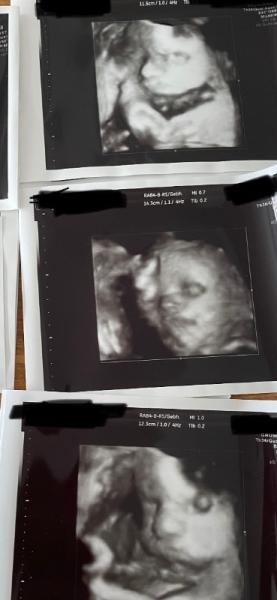 Bild zu 3D-Ultraschall komisches Auge? - Schwanger - wer noch? Rund um die Schwangerschaft