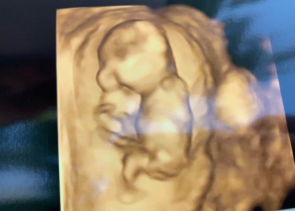 Bild zu 14 ssw 3D ultraschall - Schwanger - wer noch? Rund um die Schwangerschaft