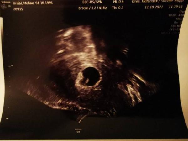Bild zu Ultraschall 7ssw- Eure Bilder bitte :') - Schwanger - wer noch? Rund um die Schwangerschaft