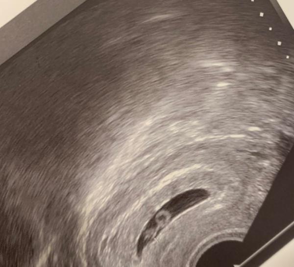 Bild zu Ersttrimester Screening - Schwanger - wer noch? Rund um die Schwangerschaft
