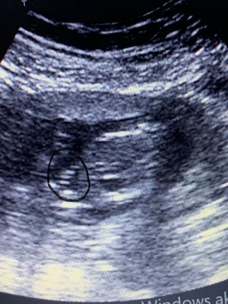 Bild zu Ist dass das Geschlecht ? - Schwanger - wer noch? Rund um die Schwangerschaft
