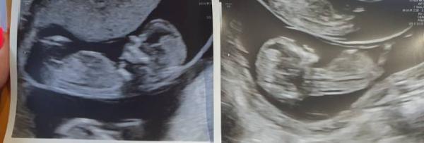 Bild zu Geschlechter Raten Twins :) - Schwanger - wer noch? Rund um die Schwangerschaft