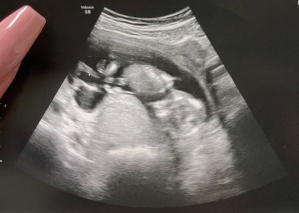 Bild zu Erkennt ihr das Geschlecht? 🙈💙💗 - Schwanger - wer noch? Rund um die Schwangerschaft