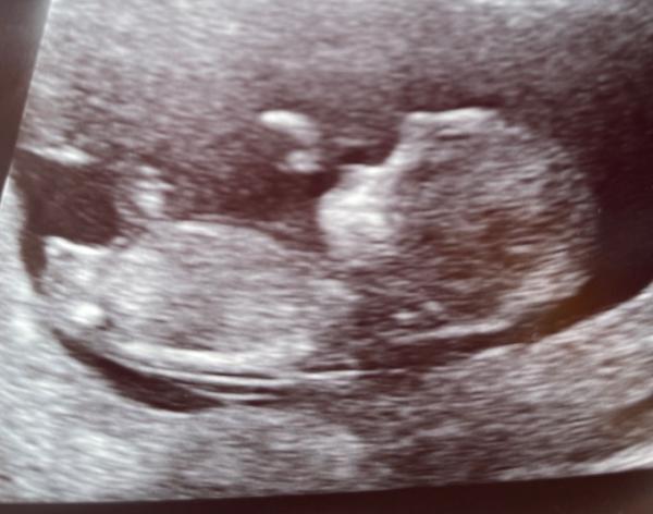 Bild zu Nub 11+5? - Schwanger - wer noch? Rund um die Schwangerschaft