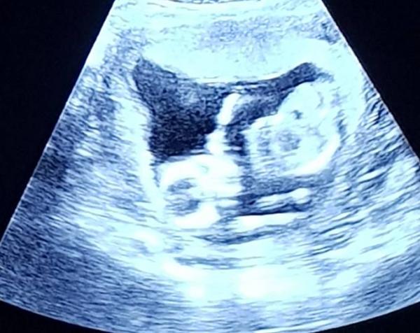 Bild zu Heutiger Termin -US - Schwanger - wer noch? Rund um die Schwangerschaft