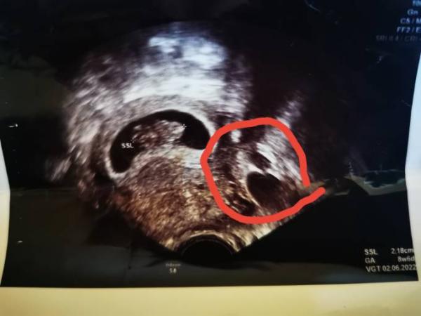 Bild zu Ultraschall frage an alle: zweite fruchtblase oder was? - Schwanger - wer noch? Rund um die Schwangerschaft
