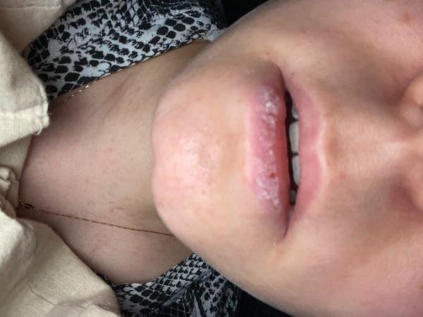 Bild zu Herpes? - Schwanger - wer noch? Rund um die Schwangerschaft