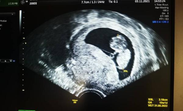 Bild zu Angel sound fetal doppler - Schwanger - wer noch? Rund um die Schwangerschaft