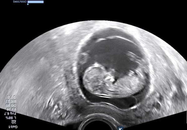 Bild zu NUB Theorie - Schwanger - wer noch? Rund um die Schwangerschaft