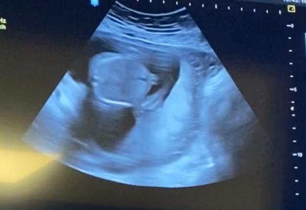 Bild zu Geschlecht an Hand von Ultraschall erkennen? SSW17 - Schwanger - wer noch? Rund um die Schwangerschaft