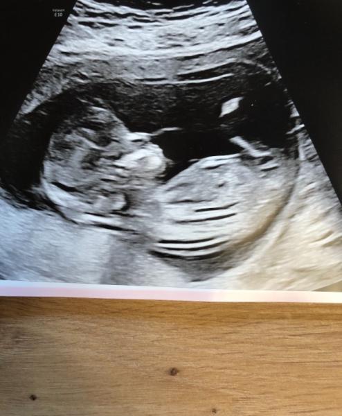 Bild zu Nub oder skull Tipps ?? - Schwanger - wer noch? Rund um die Schwangerschaft