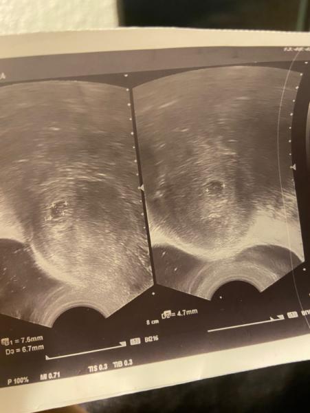 Bild zu 6 SSW Erkennt ihr was? - Schwanger - wer noch? Rund um die Schwangerschaft
