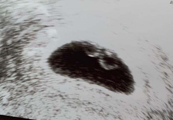 Bild zu 7 ssw kein Herzschlag - Schwanger - wer noch? Rund um die Schwangerschaft