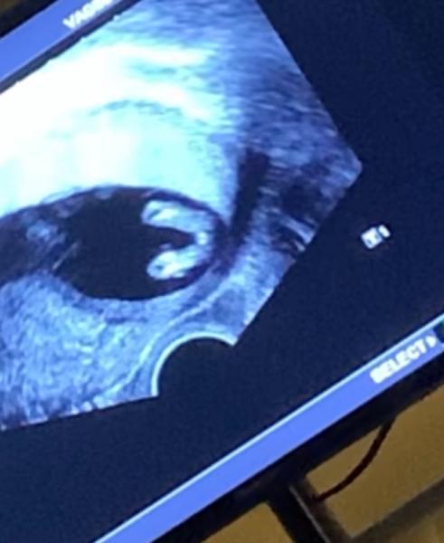 Bild zu Baby - Schwanger - wer noch? Rund um die Schwangerschaft