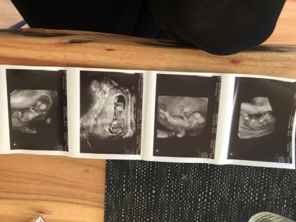 Bild zu Mädchen oder Junge - Schwanger - wer noch? Rund um die Schwangerschaft