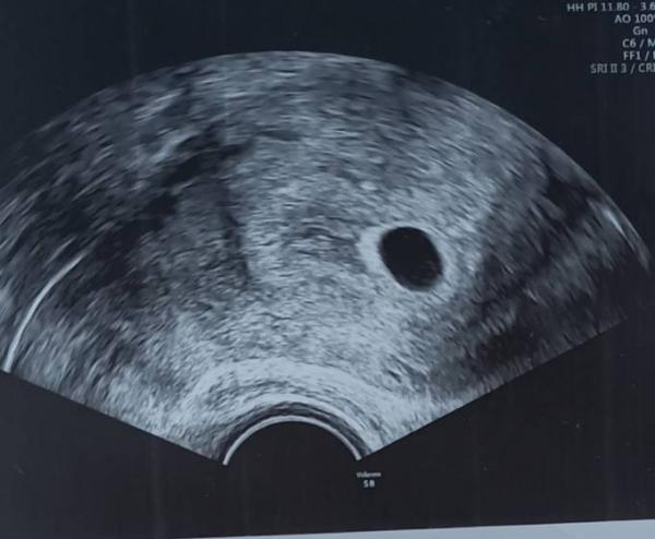 Bild zu Fühle mich einfach nur leer - Schwanger - wer noch? Rund um die Schwangerschaft
