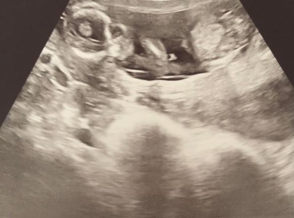 Bild zu Mädchen oder Junge? - Schwanger - wer noch? Rund um die Schwangerschaft