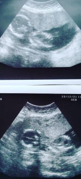Bild zu 19 SSW und Baby wollte sich nicht zeigen - Schwanger - wer noch? Rund um die Schwangerschaft