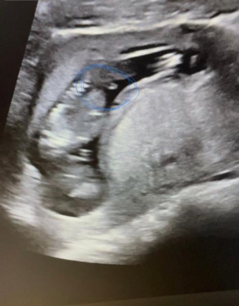 Bild zu Ist das ein Junge ? - Schwanger - wer noch? Rund um die Schwangerschaft