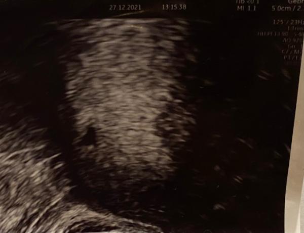 Bild zu Ultraschall 5+0 - Schwanger - wer noch? Rund um die Schwangerschaft