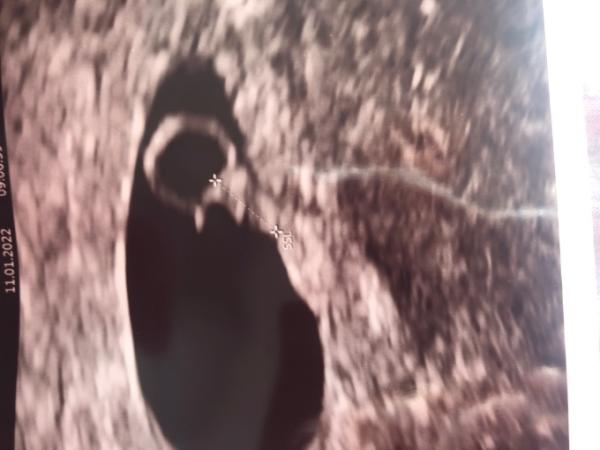 Bild zu SSW 7 (6+3) Ultraschall, dottersack groß? - Schwanger - wer noch? Rund um die Schwangerschaft