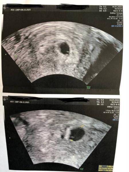 Bild zu 5+4 SSW und noch kein Dottersack/Embryo zu erkennen? - Schwanger - wer noch? Rund um die Schwangerschaft