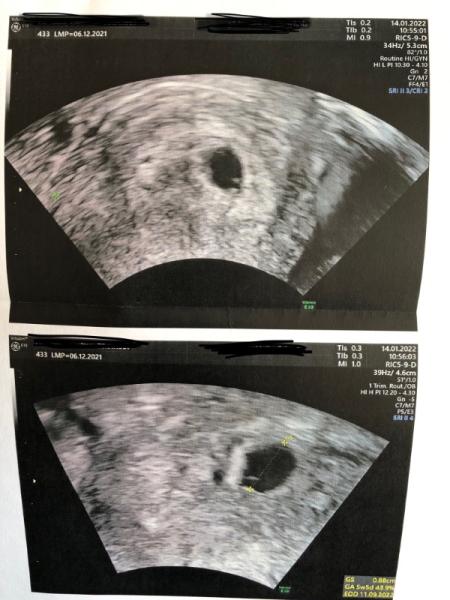 Bild zu Ist das ein Dottersack/Embryo? - Schwanger - wer noch? Rund um die Schwangerschaft