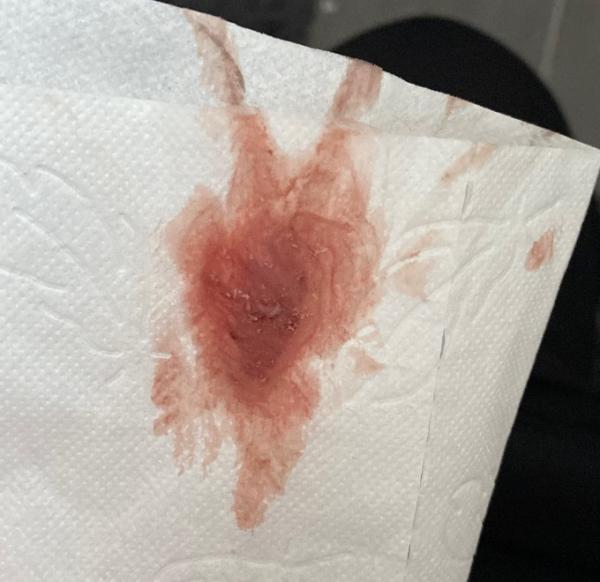 Bild zu 8ssw erst schmierblutung jetzt Blutung - Schwanger - wer noch? Rund um die Schwangerschaft