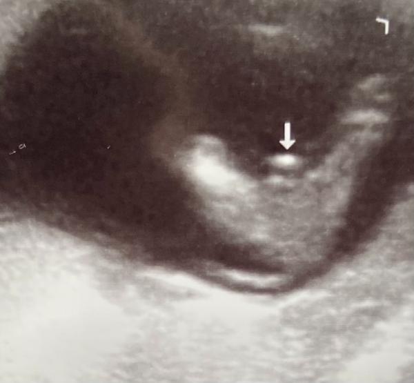 Bild zu Junge oder Mädchen?? 14 SSW - Schwanger - wer noch? Rund um die Schwangerschaft
