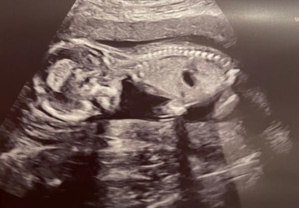 Bild zu Mädchen 👧🏼 oder Junge 👦 - Schwanger - wer noch? Rund um die Schwangerschaft
