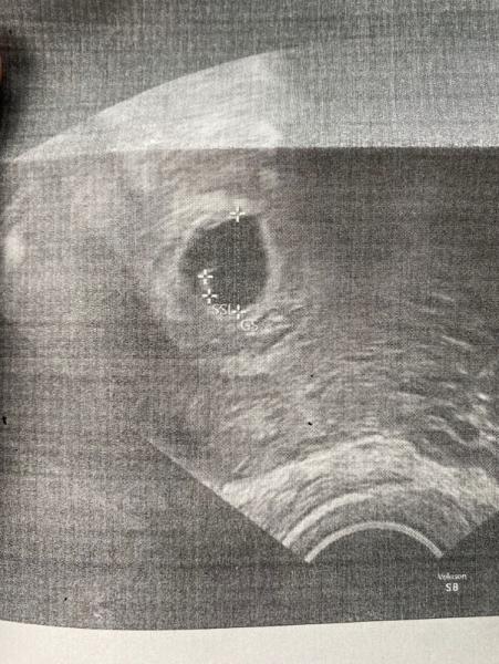 Bild zu Embryo ist da aber bisher ohne Herzschlag - Schwanger - wer noch? Rund um die Schwangerschaft