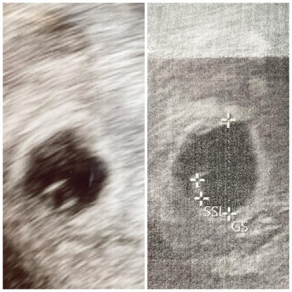 Bild zu US Bilder nach 9 Tagen - Schwanger - wer noch? Rund um die Schwangerschaft