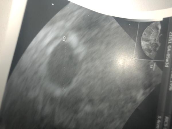 Bild zu 5+3 ss - Schwanger - wer noch? Rund um die Schwangerschaft