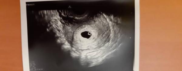 Bild zu Dottersack oder baby - Schwanger - wer noch? Rund um die Schwangerschaft