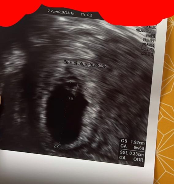 Bild zu Was erkennt ihr auf dem US? 6+6 - Schwanger - wer noch? Rund um die Schwangerschaft