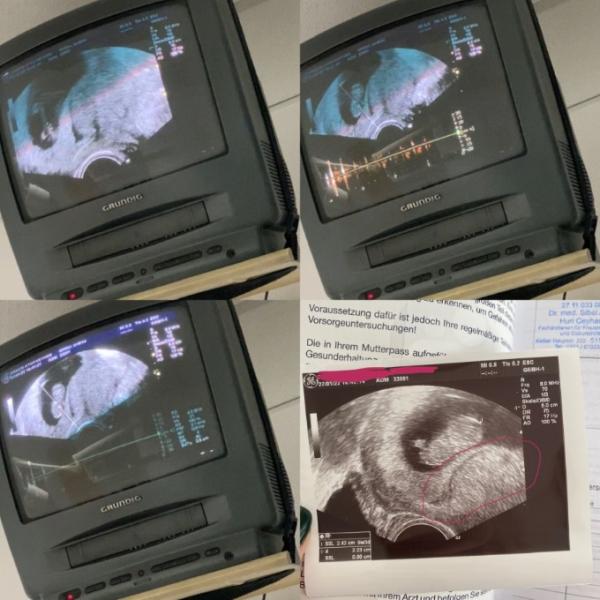 Bild zu Hämatom oder was genau ist das? - Schwanger - wer noch? Rund um die Schwangerschaft