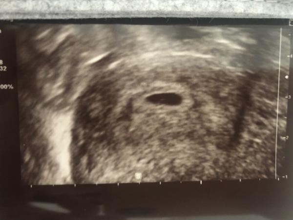 Bild zu US Bild 6+6, habt ihr ähnliche Bilder ? - Schwanger - wer noch? Rund um die Schwangerschaft